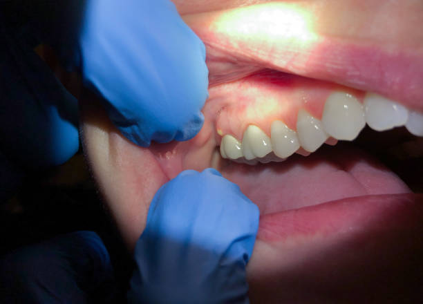 Best Emergency Wisdom Teeth Removal in Bay Minette, AL