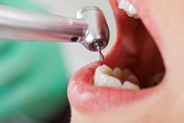 Best Emergency Broken Tooth Repair in Bay Minette, AL